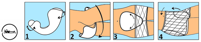 Technique de pose du Amd Form en position couché